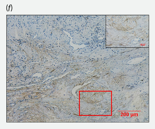  Cancer-associated fibroblasts promote PD-L1 expression in mice cancer cells via secreting CXCL5